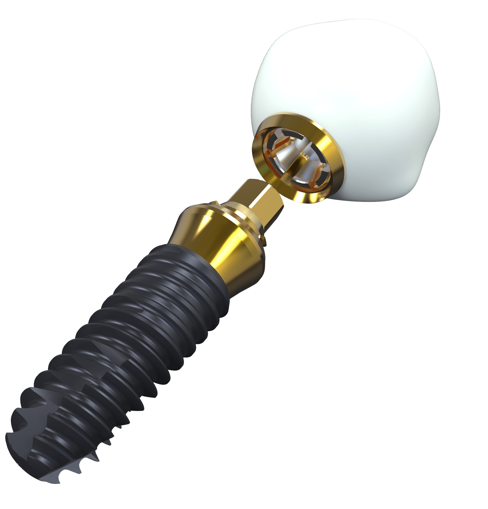 Click-Fit Aufbau: Implantat, Gold-Abutment mit innenliegender Feder und keramische Krone